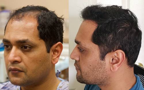 Men's Hair System