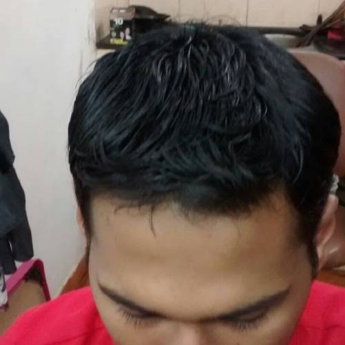 Hair Replacement Result