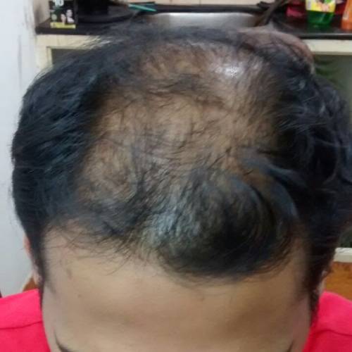 Before Hair Replacement